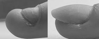 Treatment of bitten nails