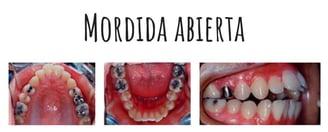 mordida abierta