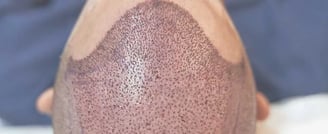 Hair Transplant  ray and rio's speciality clinic