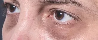 Dark Circles ray and rio's speciality clinic