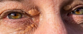 Xanthelasma Removal  ray and rio's speciality clinic