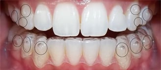 invisalign