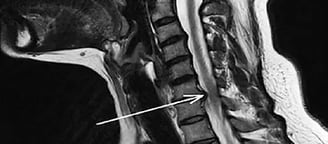 Cervical Spine And Prolapse-Dr. T. Aravindh MBBS, MS( ORTHO)