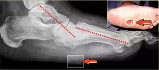 pie de Charcot