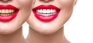 Best Teeth Whitening Service in Wadgaon sheri