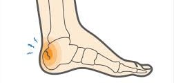 Heel Fracture- Dr. T. Aravindh MBBS, MS( ORTHO)
