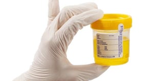 campione di orina da esaminare