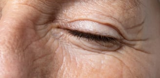 skin wrinlkes and fine lines