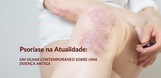 Psoríase Na Atualidade