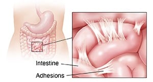 Adhesions GASTRO FOUNDATION