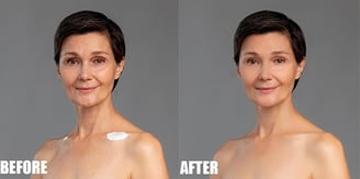 Remove Wrinkles Before and After 