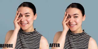 pimple-or-acne-removal