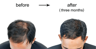 How Does Caffeine Shampoo Combat Hair Loss?