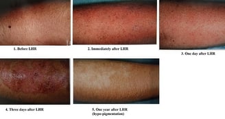 lhr-on-recent-sun-exposed-skin