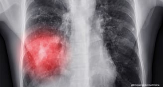 Enfermedades producidas por el polvo de uñas - Neumonitis