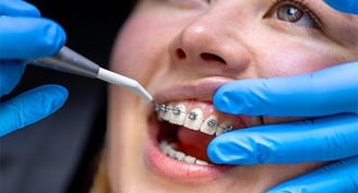 hygiène orthodontie soin jet dentaire ozone Aquolab hygiene-precision.com