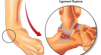 Ligament Injury- Dr. T. Aravindh MBBS, MS( ORTHO)
