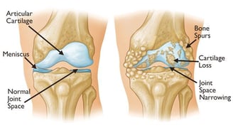 Arthritis / Osteoarthritis- Dr. T. Aravindh MBBS, MS( ORTHO)