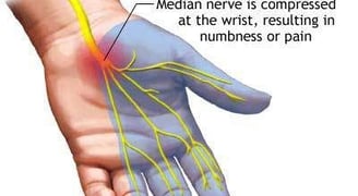Carpal Tunnel Syndrome- Dr. T. Aravindh MBBS, MS( ORTHO)