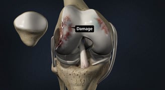 Avasular necrosis Knee- Dr. T. Aravindh MBBS, MS( ORTHO)