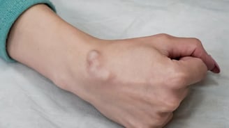 Ganglion Cysts- Dr. T. Aravindh MBBS, MS( ORTHO)