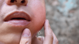 glándulas salivales cirugia de parótida y cuello