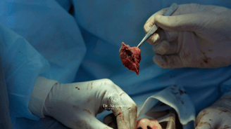 ganglios de cuello tumor de cuello biopsias