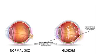 Glokom (göz tansiyonu), göz içi basıncın yükselmesi sonucu görme sinirlerine zarar verebilen ciddi bir göz hastalığıdır.