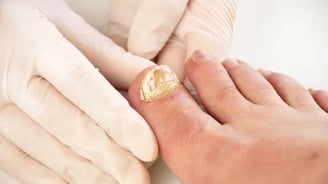 Micose de Unha ou Micose Plantar Podologia em Praia Grande