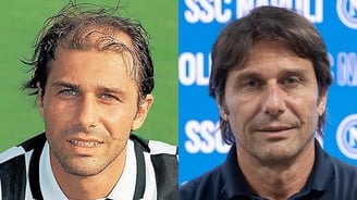 Antonio Conte hair transplant