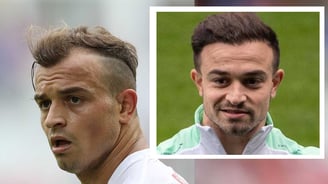 Xherdan Shaqiri hair transplant