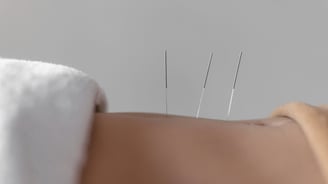 Acupuncture needles gently inserted into skin during treatment.