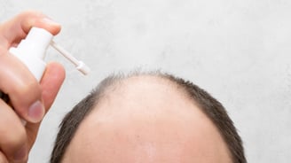 Man applying minoxidil foam to bald spot on crown area