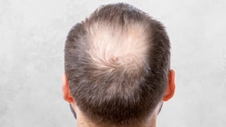 How to apply minoxidil to the scalp with dropper