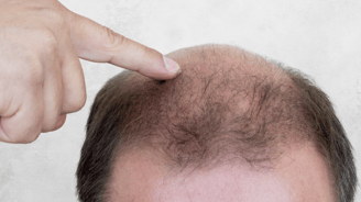 Step-by-step guide to using minoxidil for hair growth