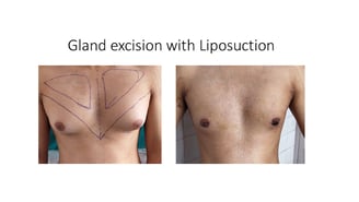 Gyanecomastia surgery Man boob surgery