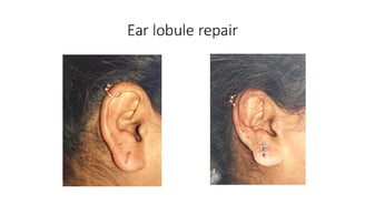 Ear lobule repair with ear piercing