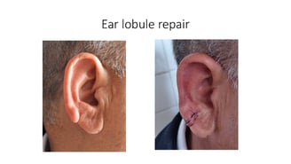 Hanging ear Large ear hole
