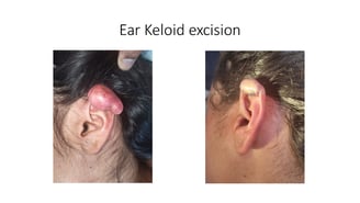 Ear keloid surgery