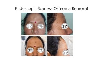 Osteoma endoscopic surgery