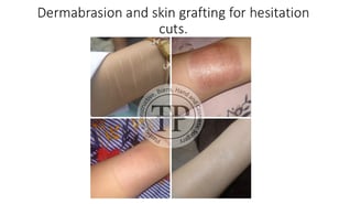 Self harm hesitation cuts