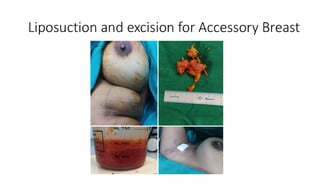 Axillary breast liposuction