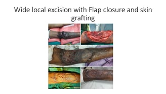 Skin cancer flap skin grafting