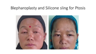 Droopy eyelids Ptosis surgery