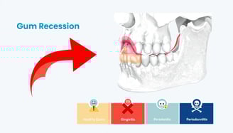 receding gums
