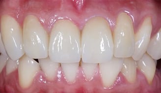 Sorriso in Zirconia