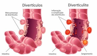 Imagem exibindo divertículos do intestino grosso e quadro de divereticulite