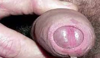 secrezione uretrale gonorrea