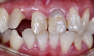 Prima: denti rovinati 