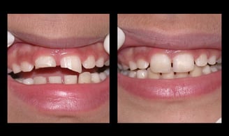 kids teeth